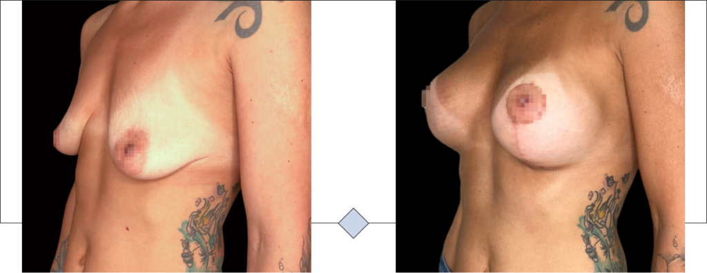 levantamiento mamario